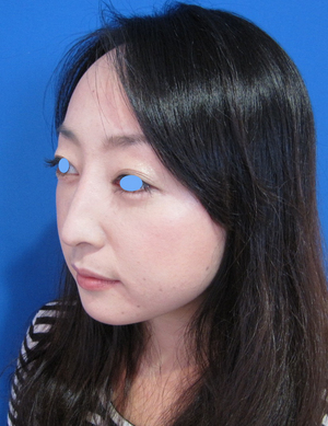 目の下のたるみ、目のくまでお悩みの方、切らずに完璧に解決します。TCB-R法　手術直後　症例写真